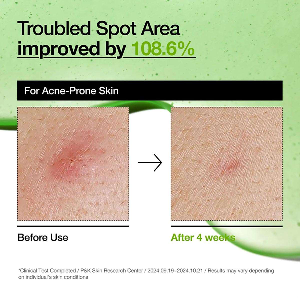ANUA Azelaic Acid 10 Hyaluron Redness Soothing Serum 30ml - Pack Of 2